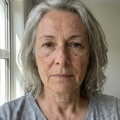 Before - Margaret, 63