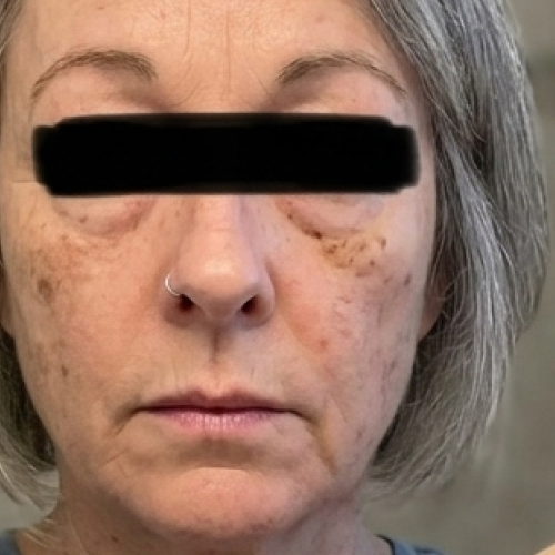 Before - Diane, 58
