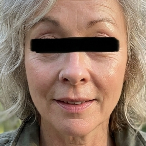After - Diane, 58