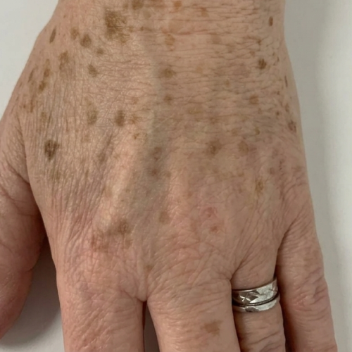 Before - Carol, 64