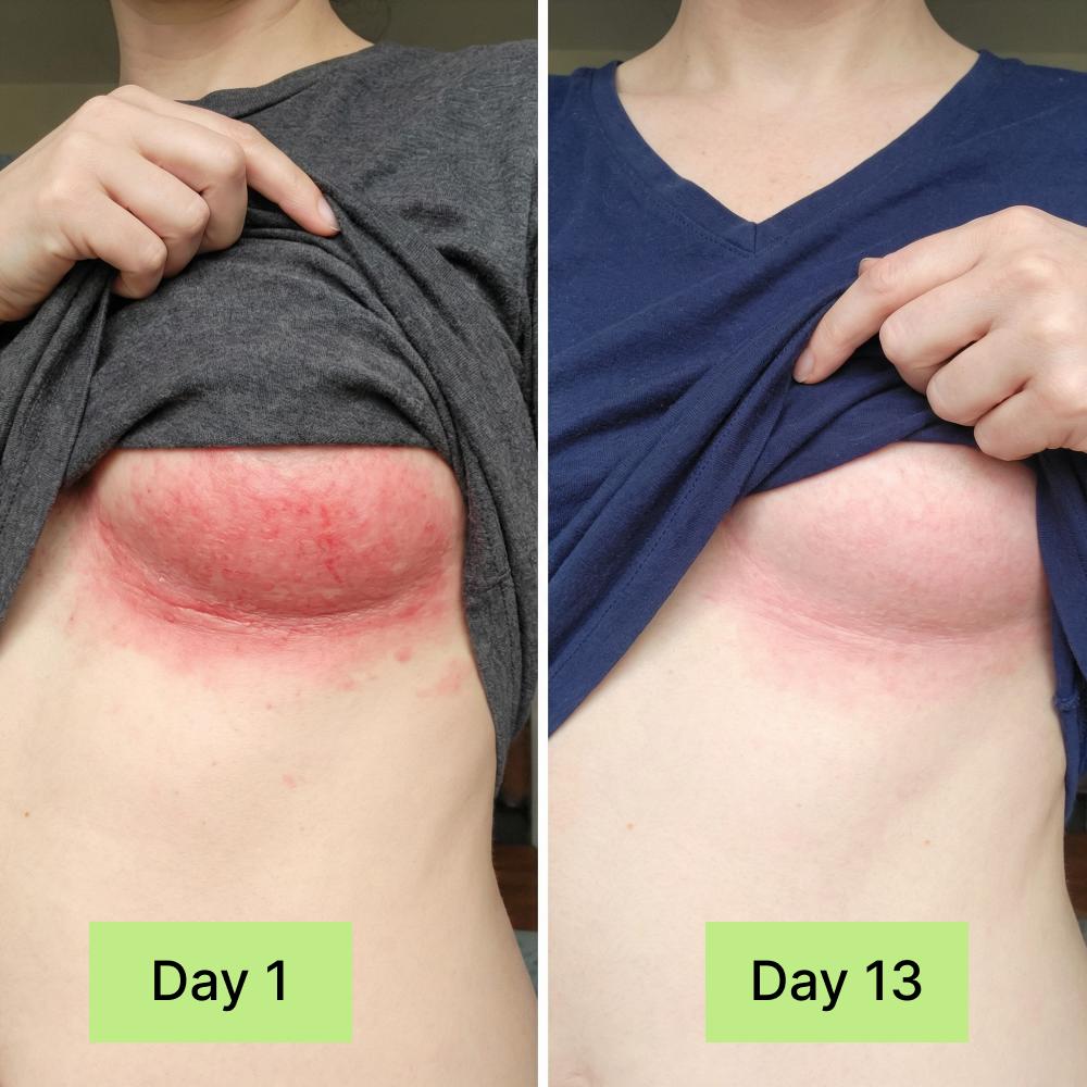 Clinical Antifungal Soap