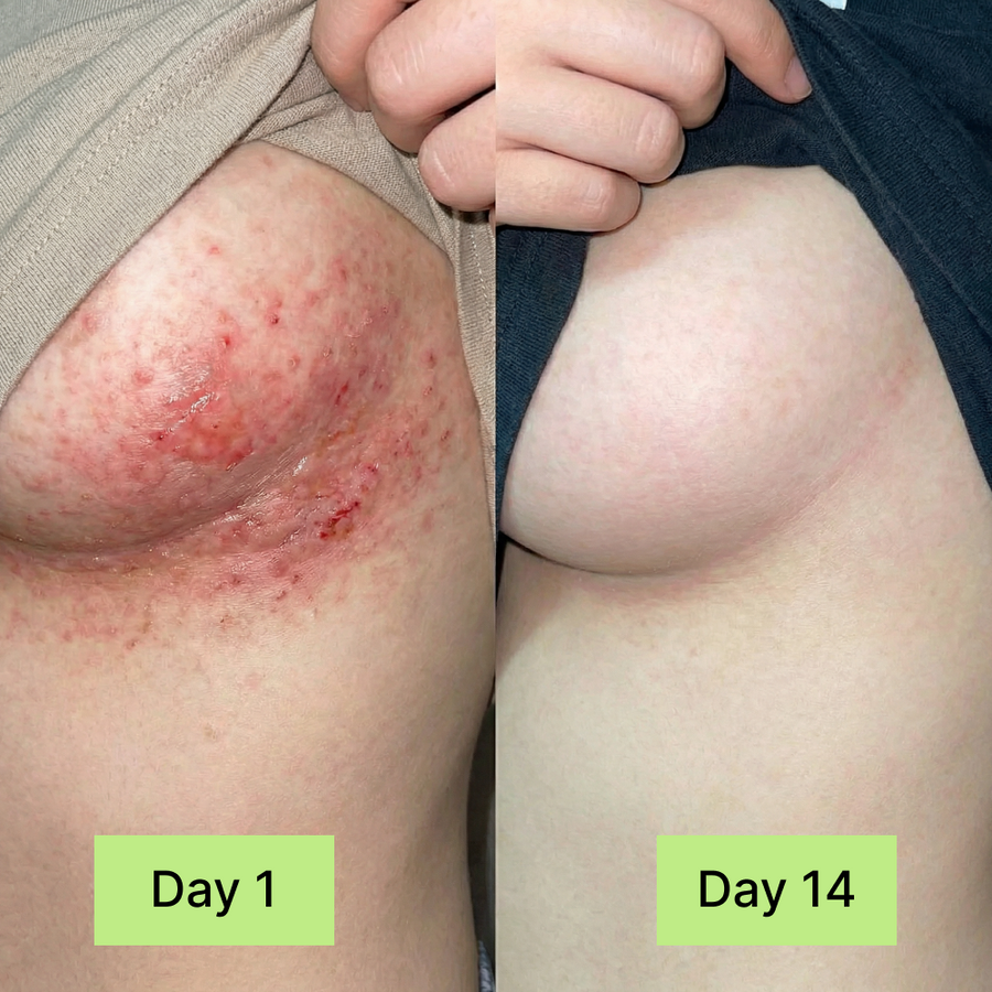 Clinical Antifungal Soap